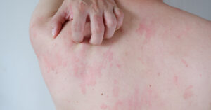 Allergic skin reactions